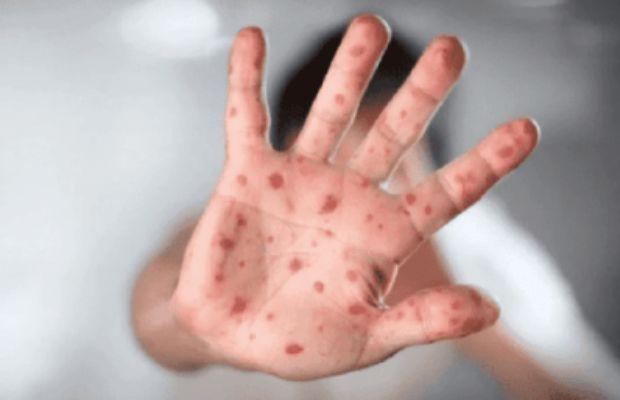 first suspected case of Monkeypox